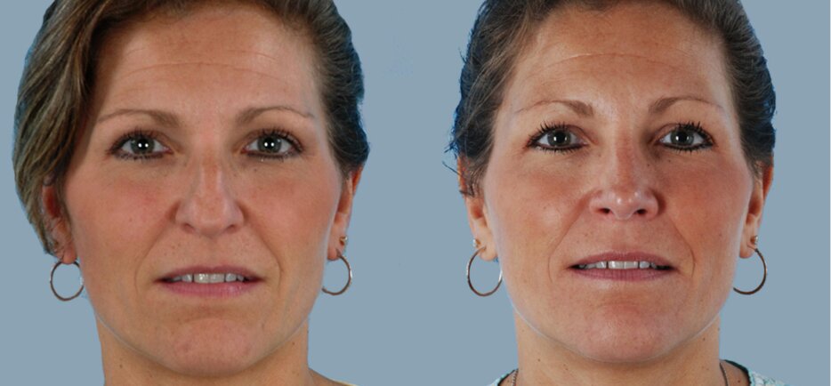 Rhinoplasty New Jersey | Nose Surgery Toms River | Rhinoplasty Clinic